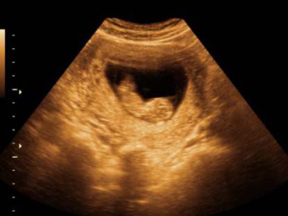 Ecografia di un feto nel primo trimestre