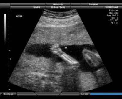 Ecografia di un feto al secondo trimestre di gravidanza