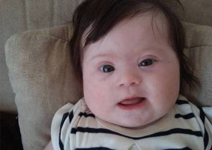  bimba con la Sindrome di Down,