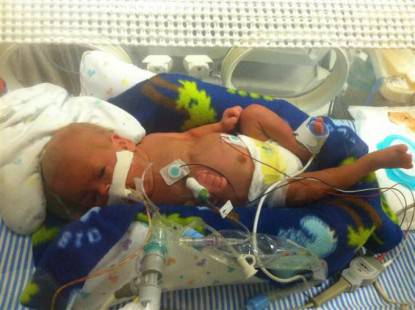bambino prematuro