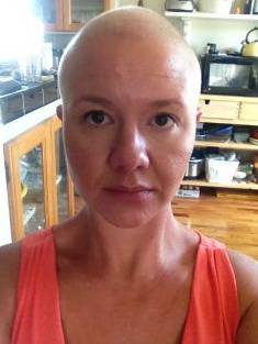alopecia in gravidanza 2