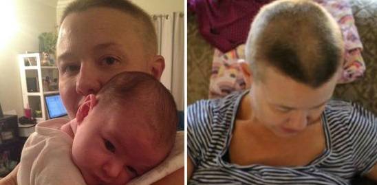 alopecia in gravidanza 3