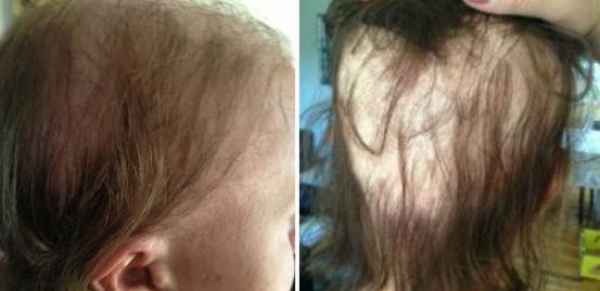 alopecia in gravidanza 4