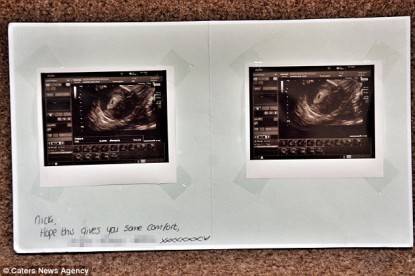 ecografia feto abortito