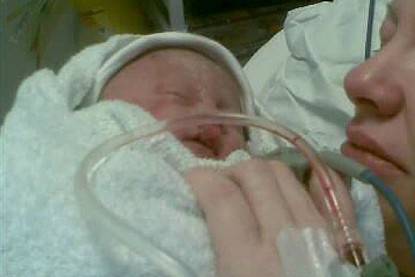 bambina con malattia rara