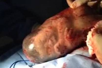 bambino in sacco amniotico