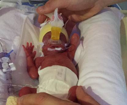 prematuro di 25 settimane dettaglio