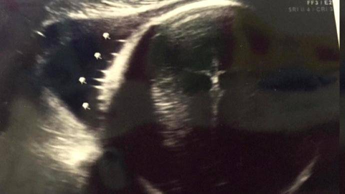 aley meyer ultrasound 3