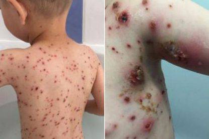 Hayley-Lyons-sons-reaction-to-Nurofen