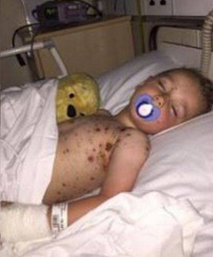 bambino con varicella