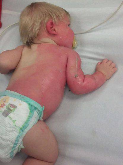 bambino ustionato
