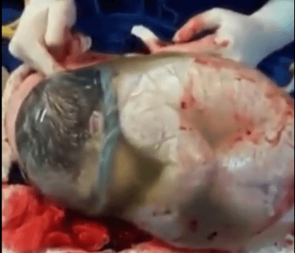 bambino nel sacco amniotico