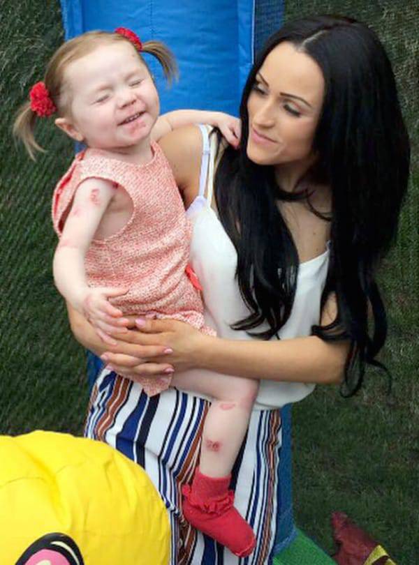 PIC FROM CATERS NEWS - (PICTURED: Danni Latham with her daughter Isla) - A young mum has been forced to defend her parenting skills after strangers presume her daughters severe skin condition is sun burn. Danni Latham, 21, from Alridge, West Mids, was devastated when midwives explained her new-born baby girl, Isla, had no skin on her hands or feet. Isla was diagnosed at eight weeks old with Epidermolysis bullosa (EB) - a rare skin condition that leaves blisters all over the body. But since her daughters birth in 2014, Danni has found herself being verbally attacked by viscous strangers who believe her skin condition in fact sun burn. SEE CATERS COPY.