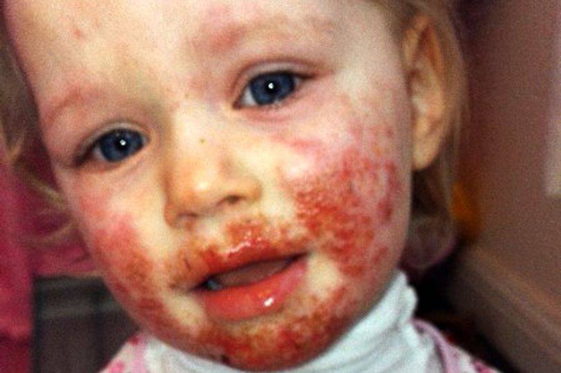 pay-child-with-herpes-on-face
