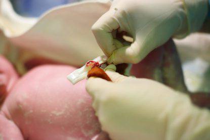 taglio del cordone ombelicale