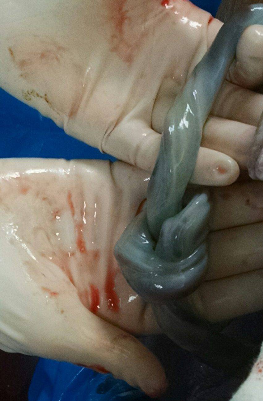 nodo del cordone ombelicale