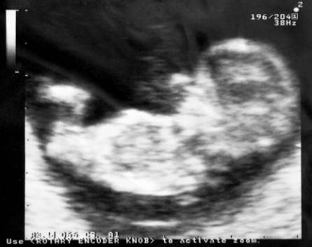 Ecografia di un feto di 11 settimane