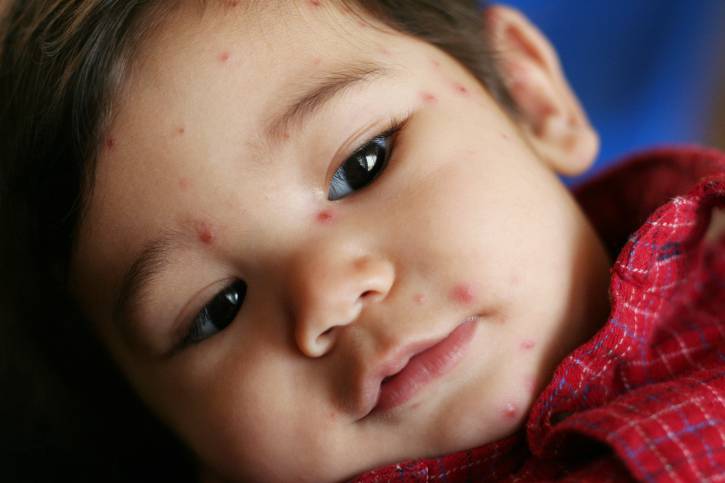 Viso di bimbo con vescicole da varicella