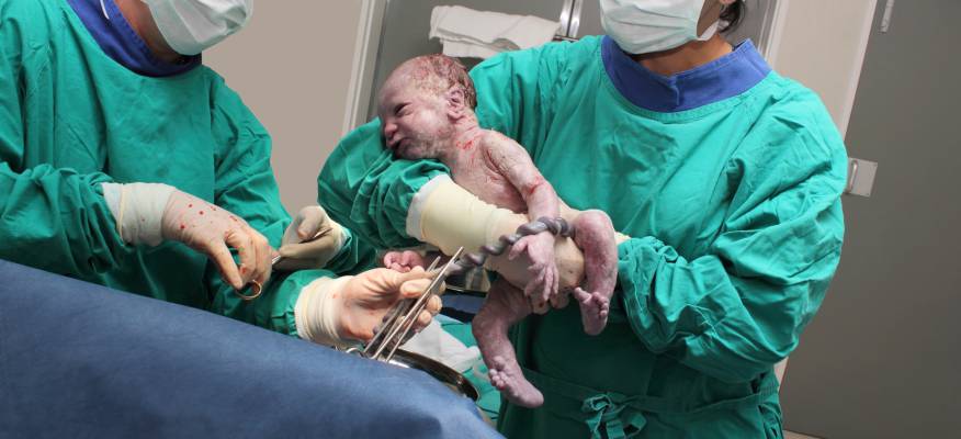 Neonato all'atto della nascita con il cordone ombelicale