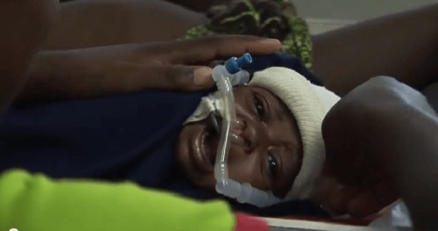 Bambina del Malawi con macchina per la ventilazione meccanica