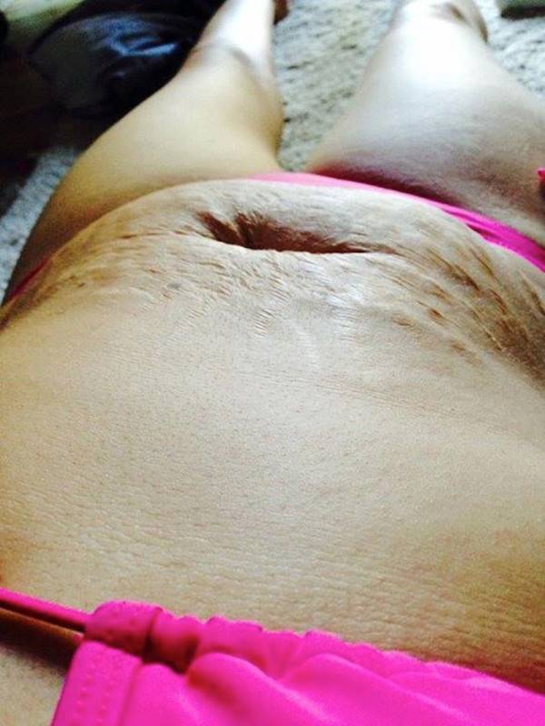 pancia con smagliature