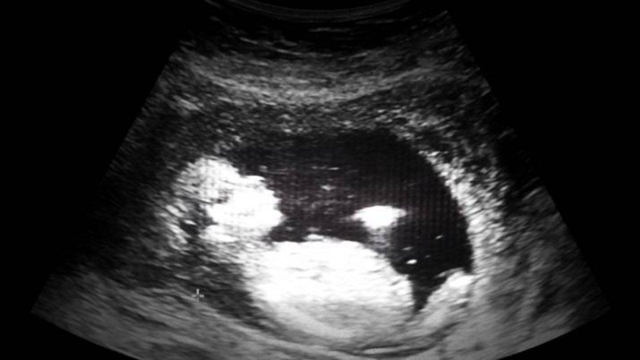 Ecografia Feto Di Eta Compresa Tra Le 8 E Le 12 Settimane Gioca Dentro La Pancia Video