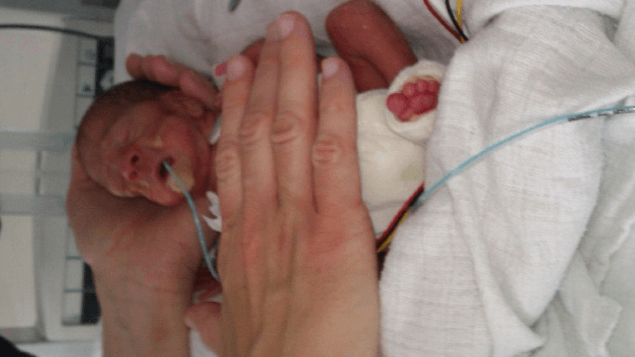 Nasce Prematura A 23 Settimane Di Gravidanza Ma Lotta E Ora Sta Bene