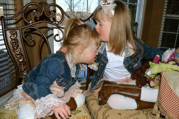 bambine sindrome di down 2