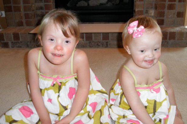 bambine sindrome di down