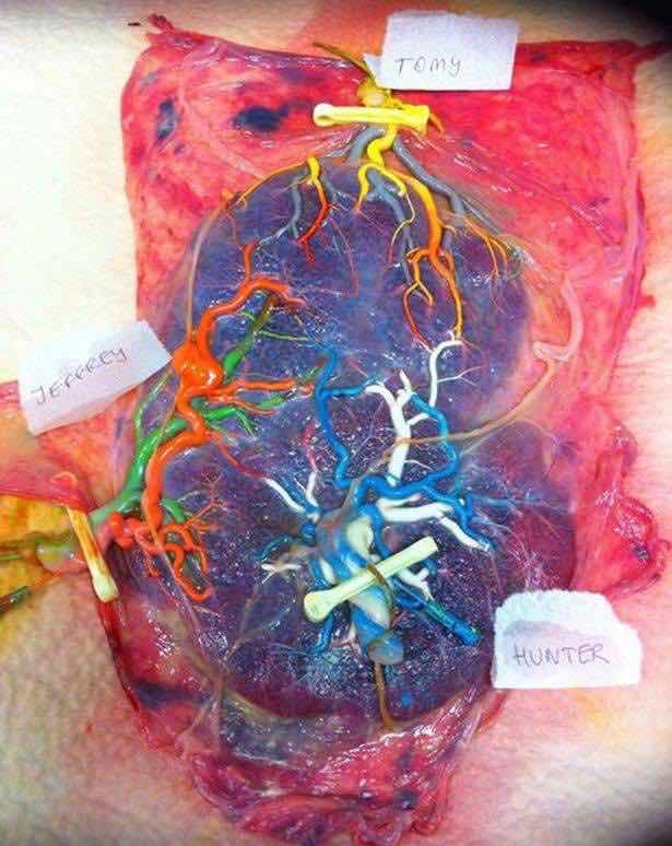 tre gemelli una placenta