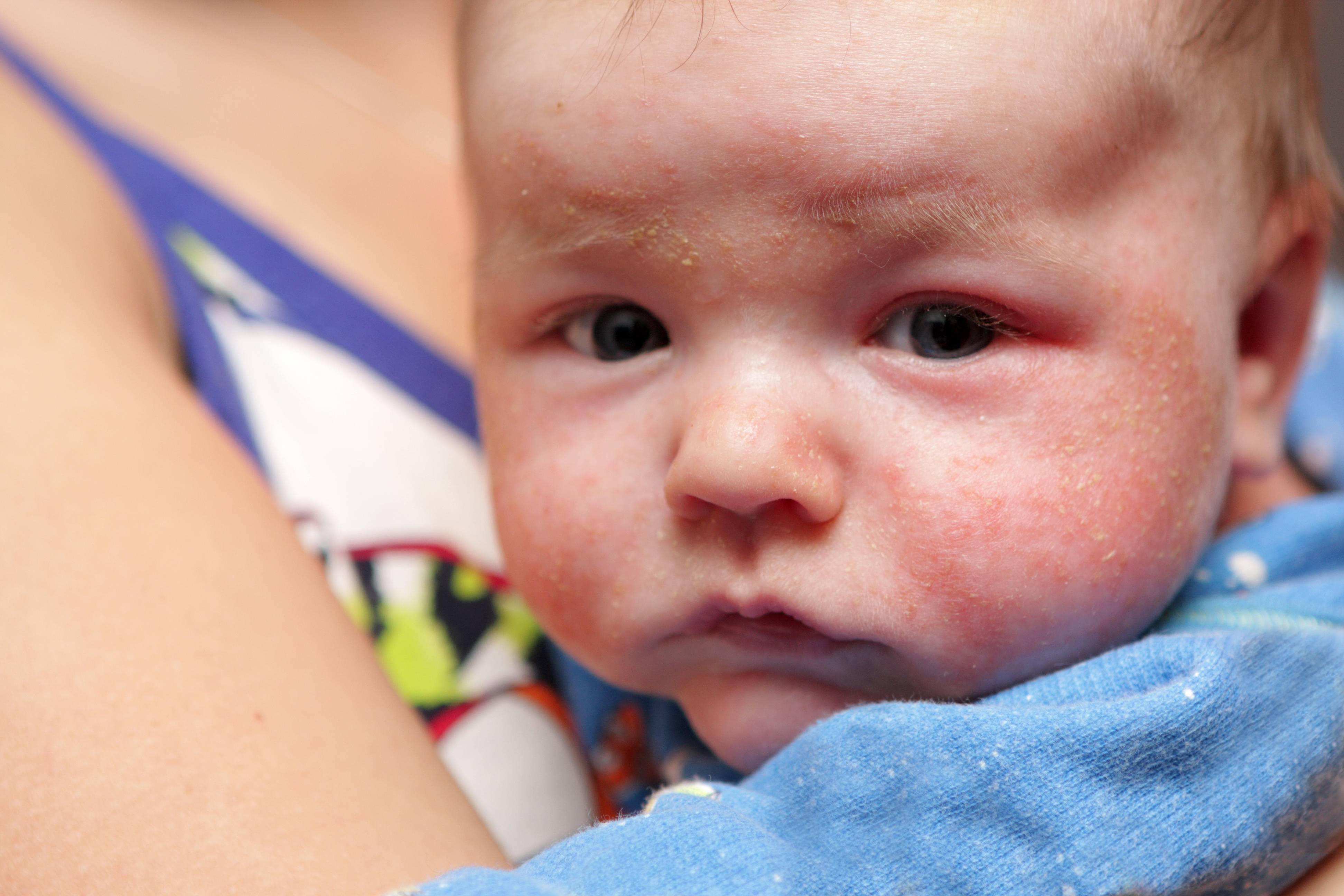 Атопич. Атопический дерматит у детей до 1 года. Себорейный дерматит у грудничка 1 месяц. Гнейс атопический дерматит. Атопический дерматит на лице у грудничка.