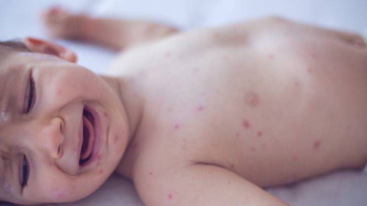 cicciobello varicella