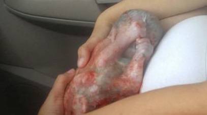 bambino nasce nel sacco amniotico