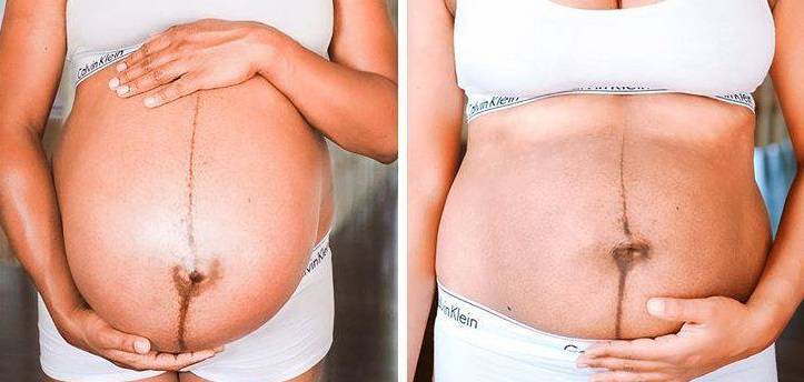 pancia dopo il parto