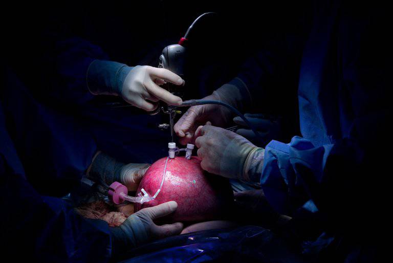 intervento in utero