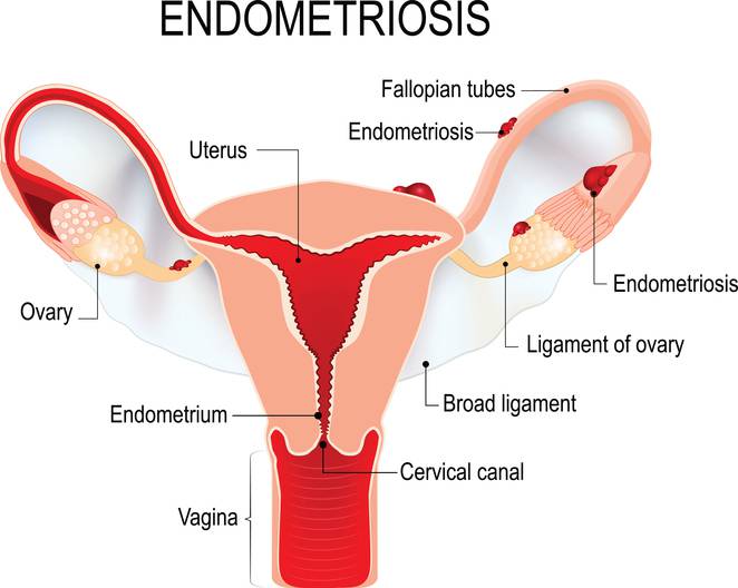 che cos'è l'endometriosi