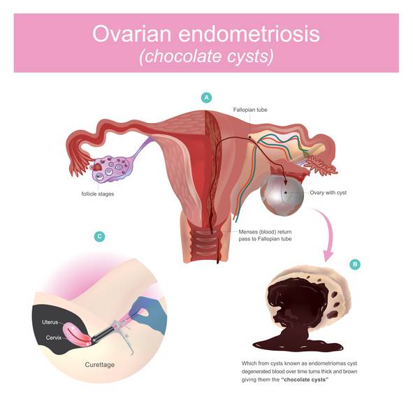menometrorragia e dolore pelvico e al seno