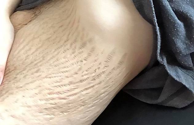 donna che ha mostrato le sue smagliature