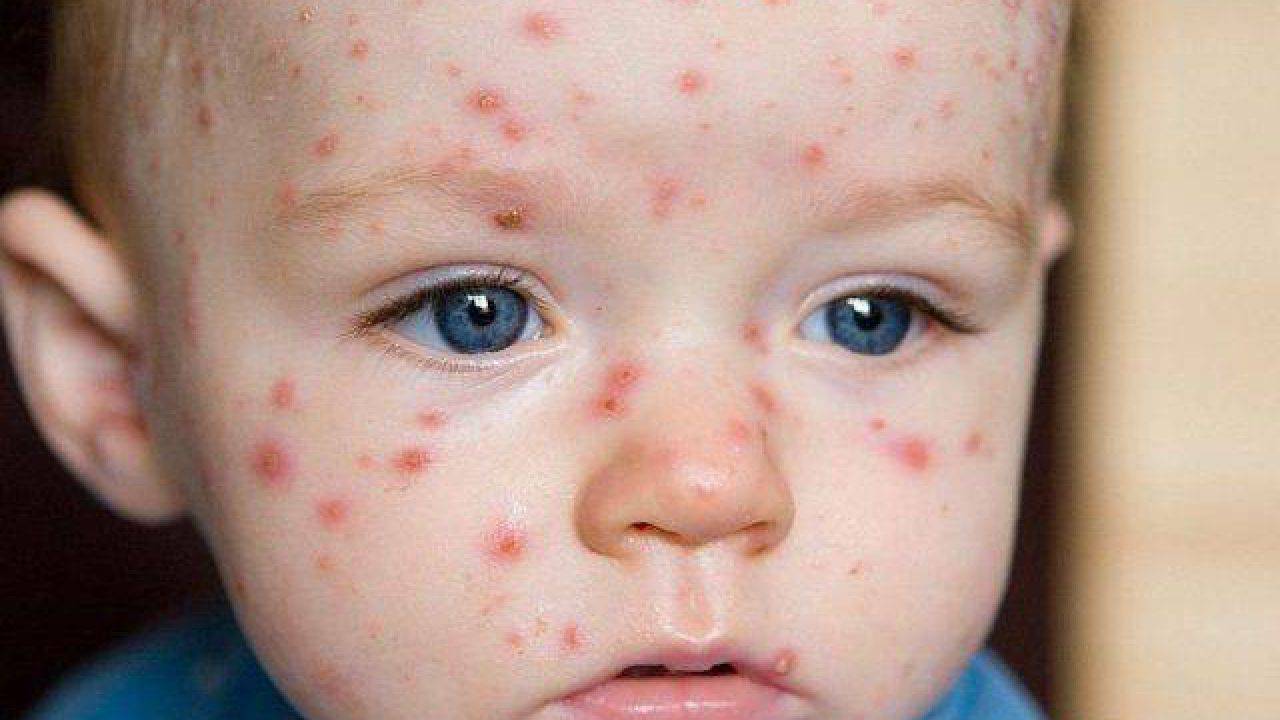 Il Virus Della Varicella In Un Bimbo Di 11 Mesi Ha Comportato Un Ictus