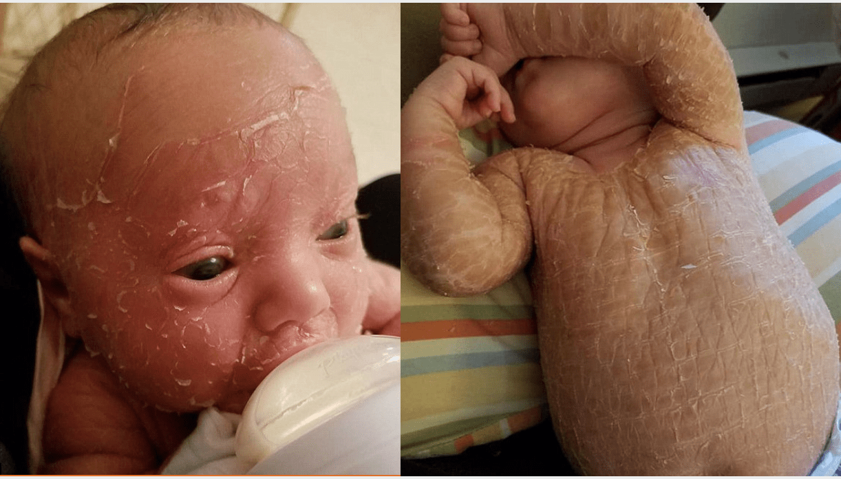 bambina ittiosi candeggina