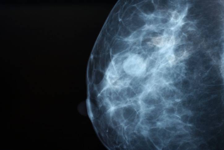 cancro al seno triplo negativo