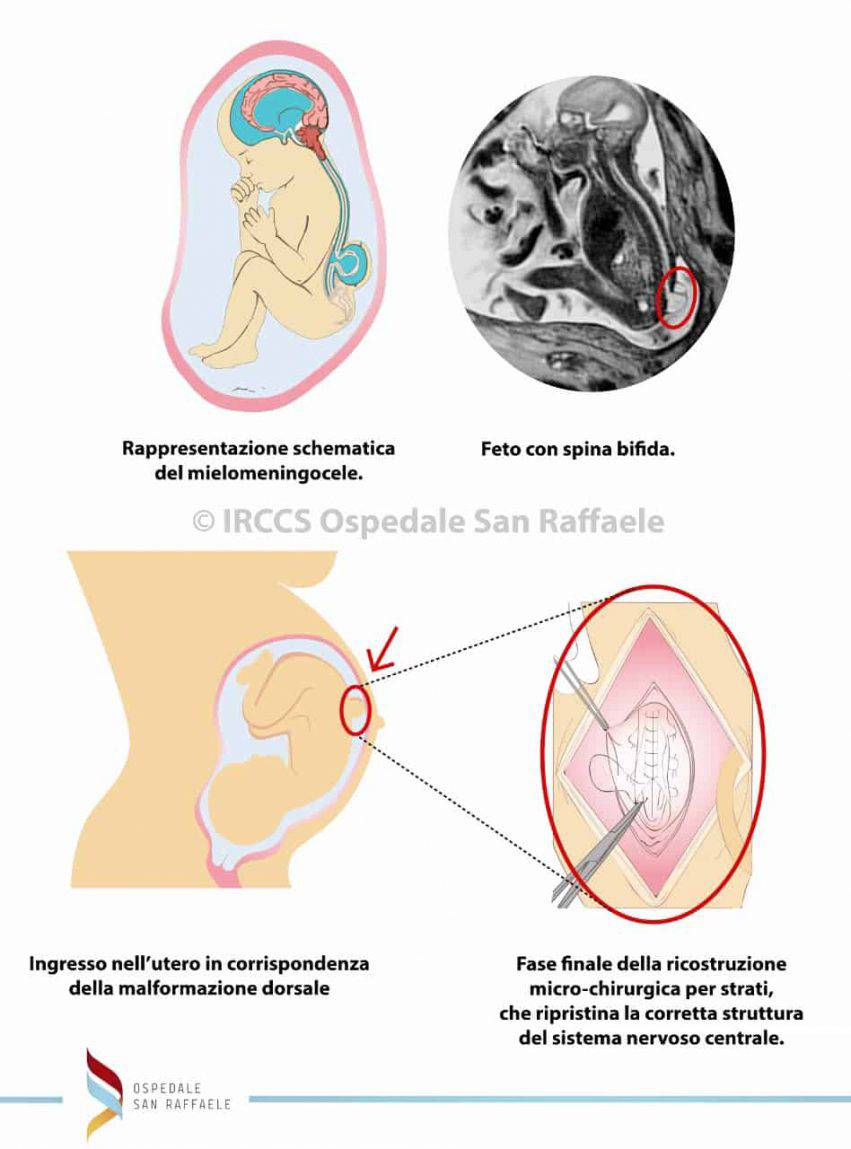 spina bifida