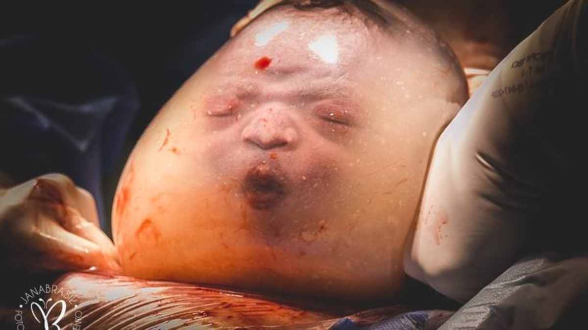 bambino nato nel sacco amniotico