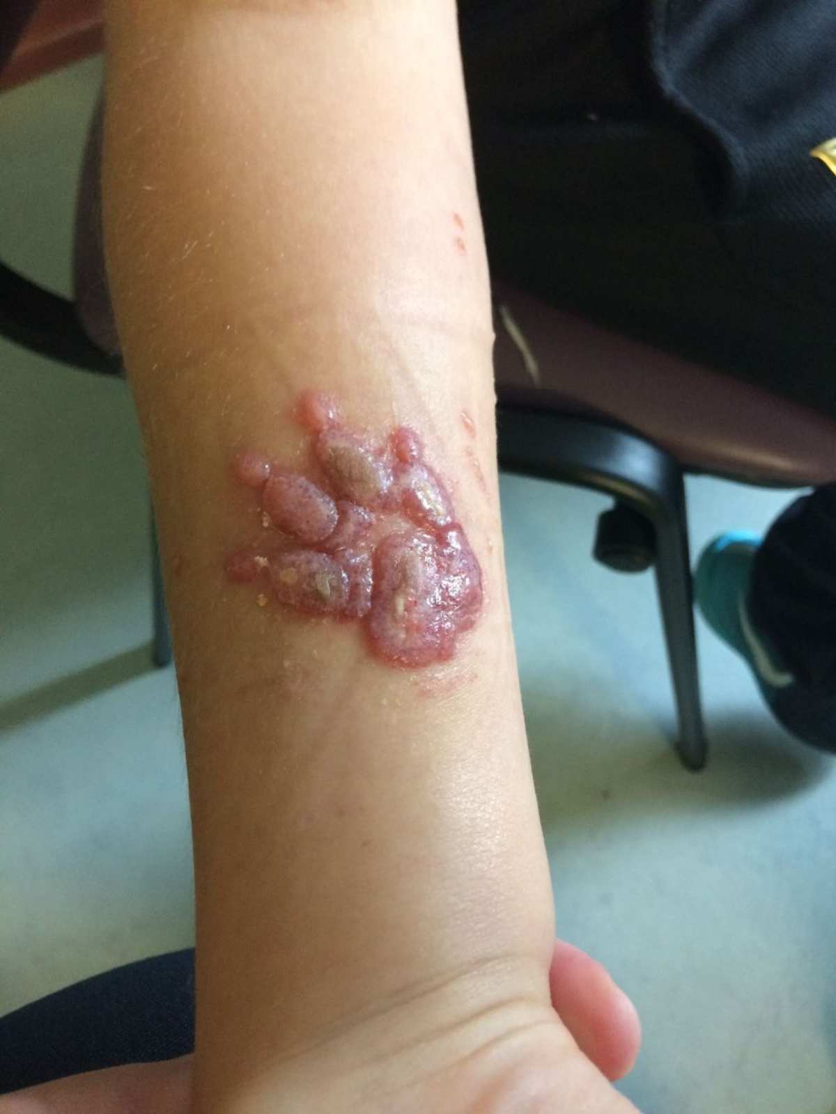 bambino bruciato dall'hennè 2