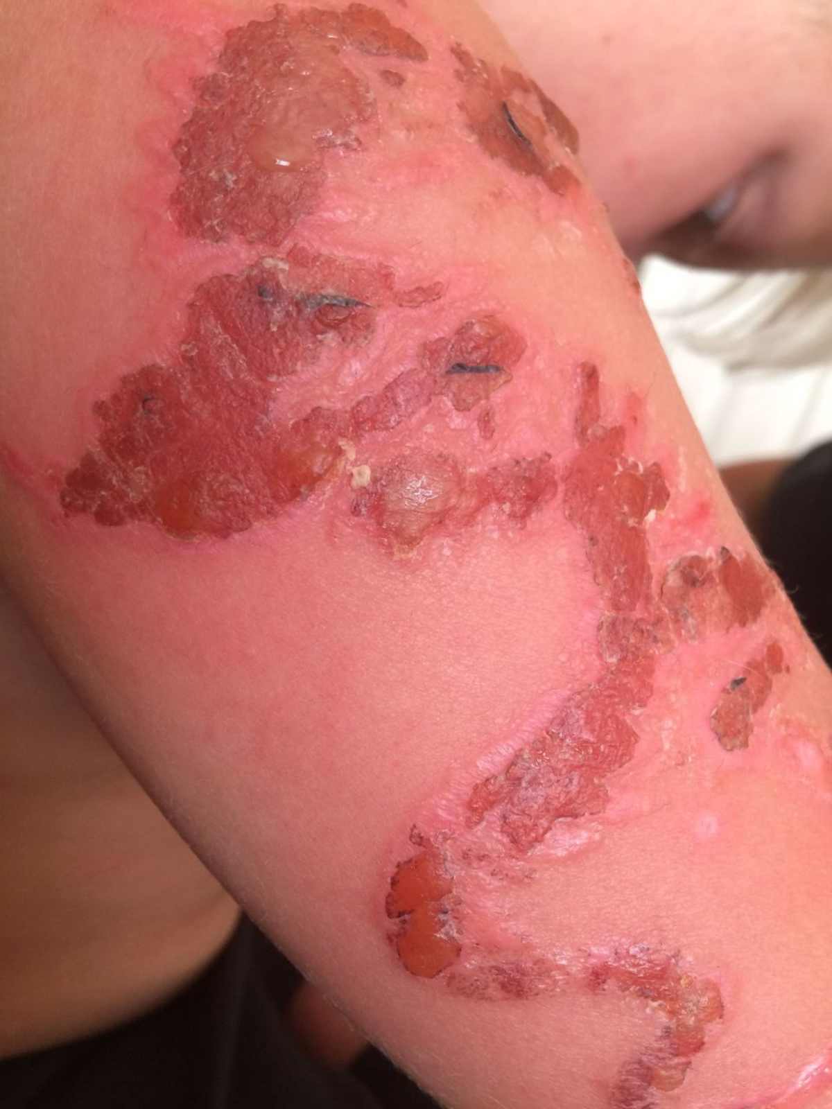 bambino bruciato dall'hennè 6