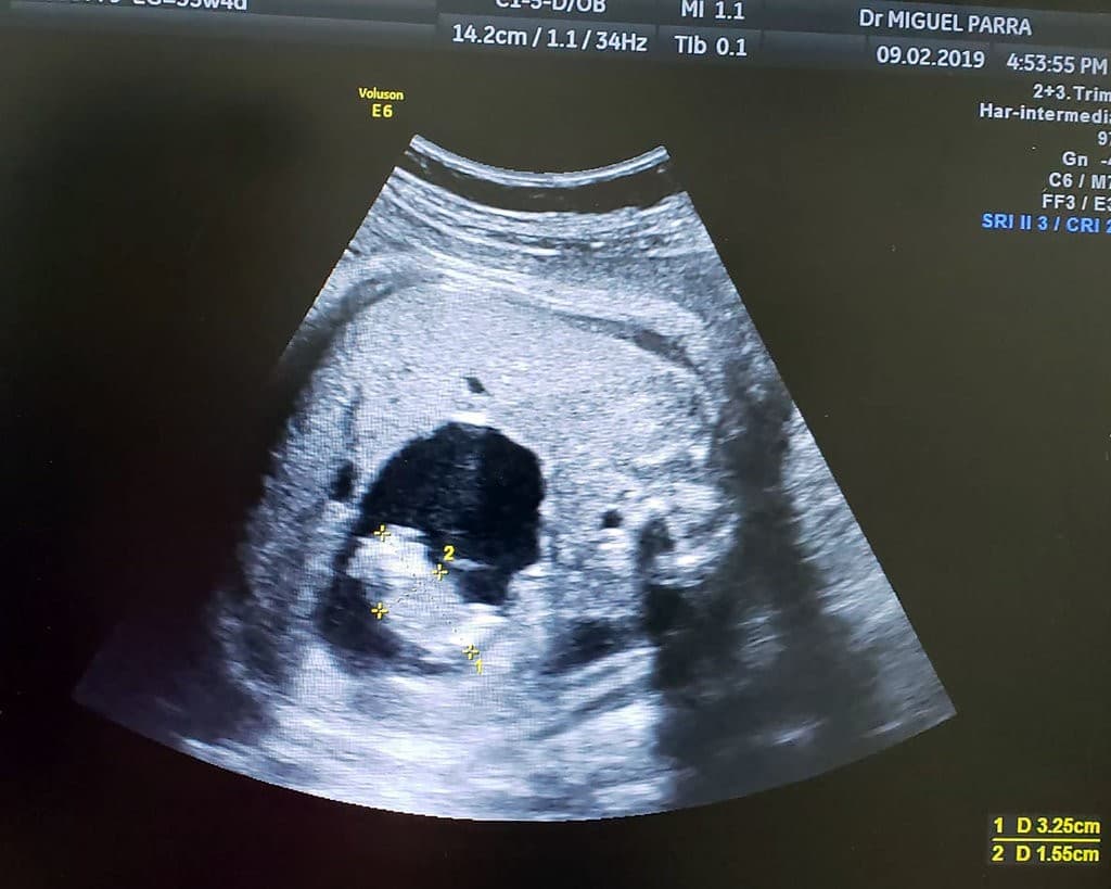 gravidanza feto nel feto