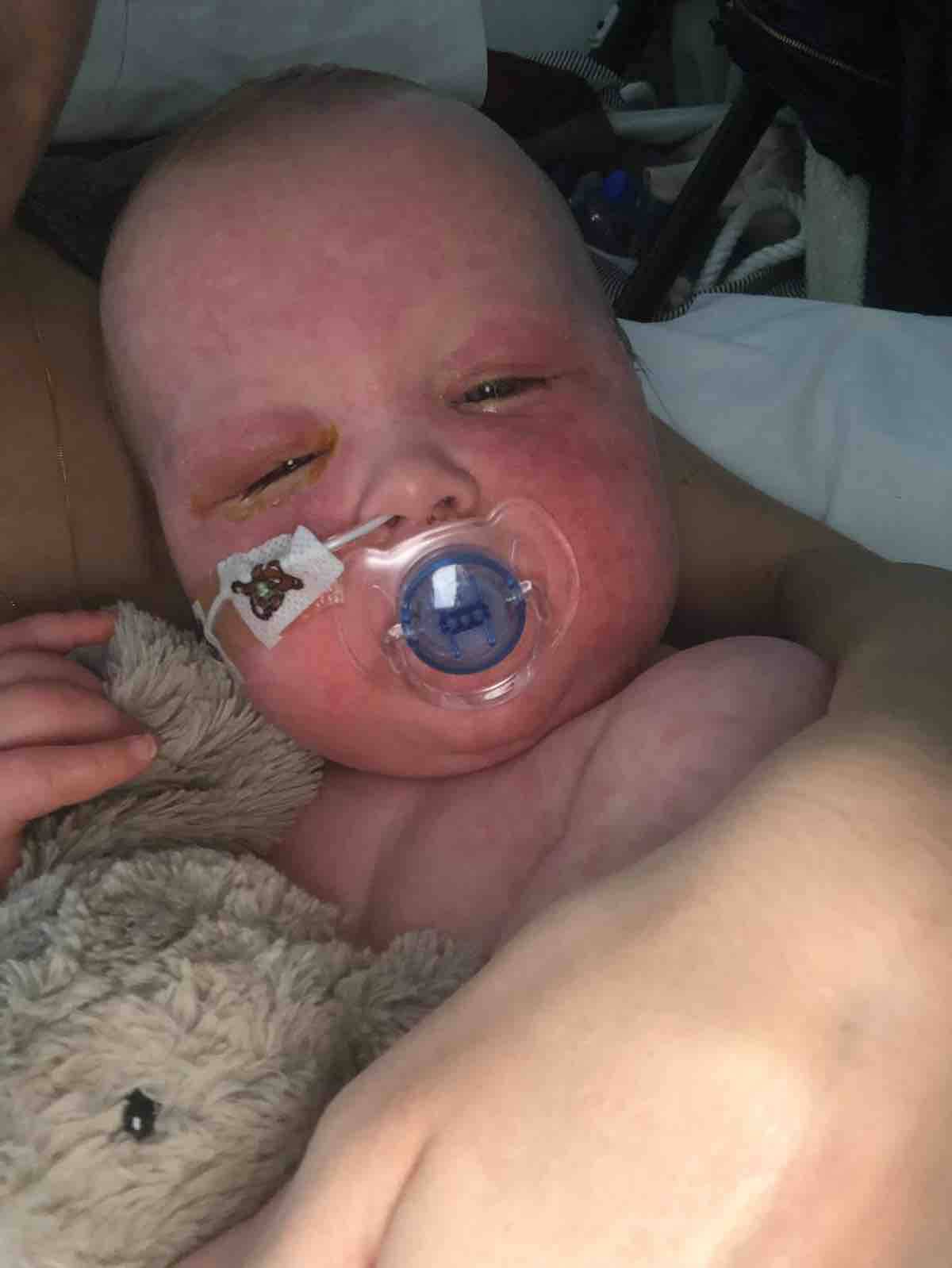 morbillo sfogo bambina