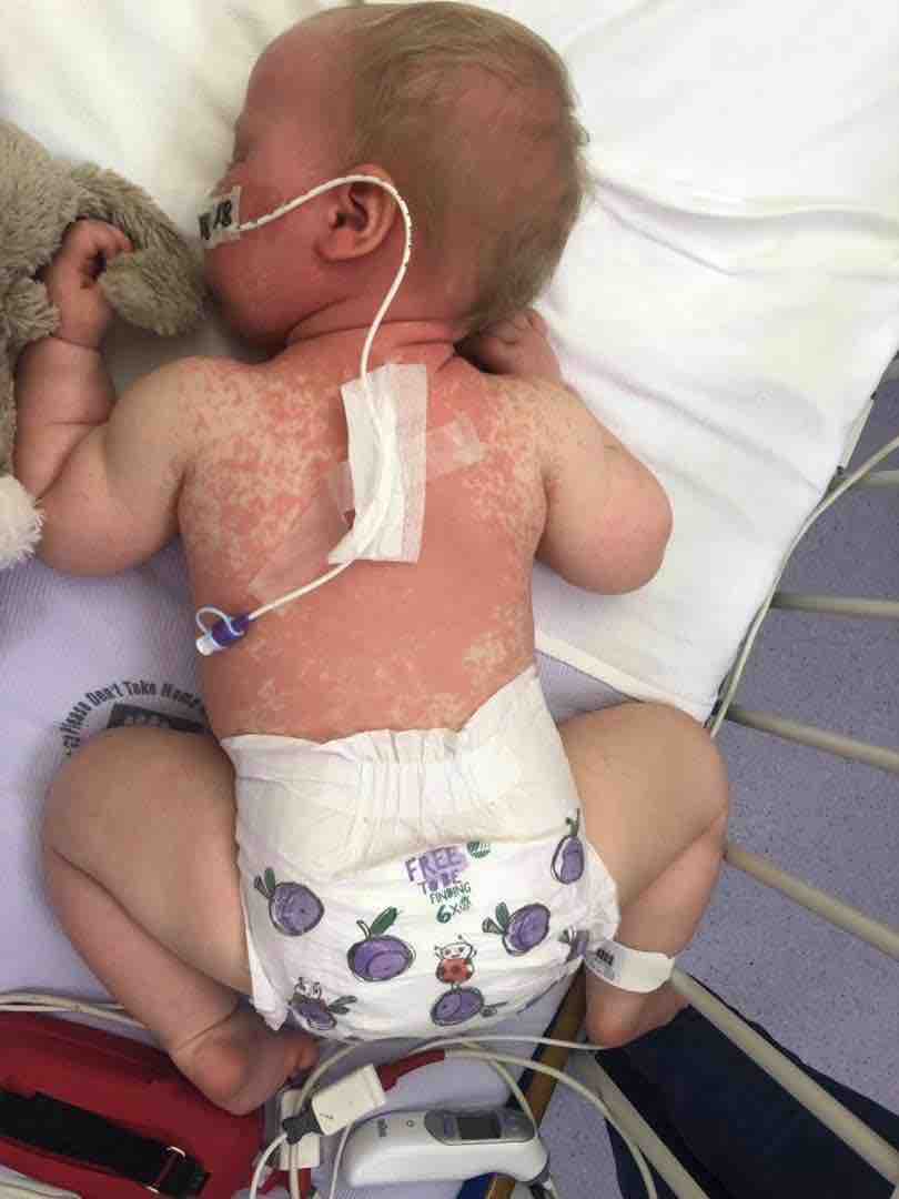 bambina morbillo vaccini