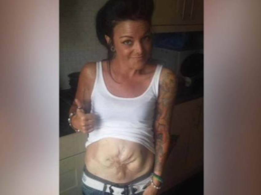 parto cesareo intestino