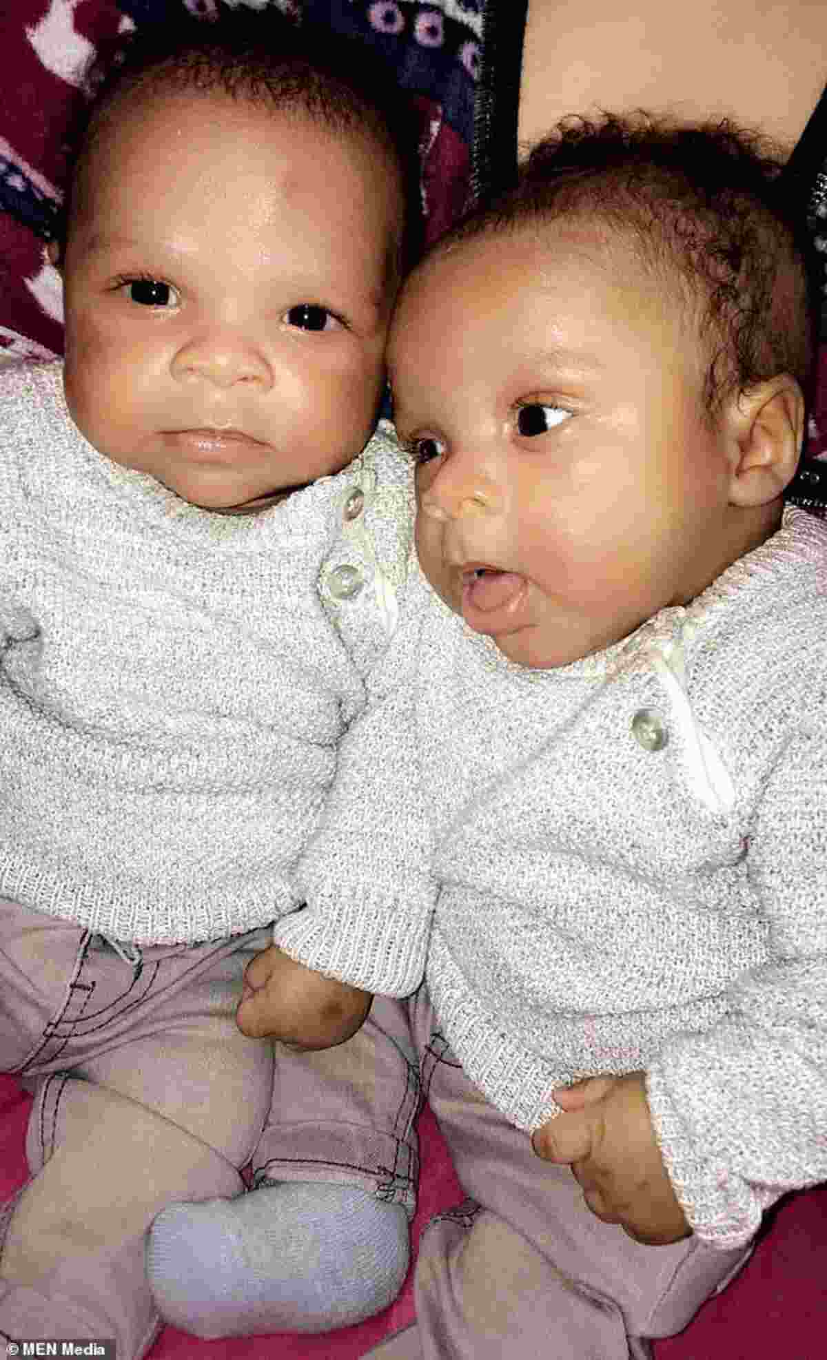 gemelli con leucemia 3